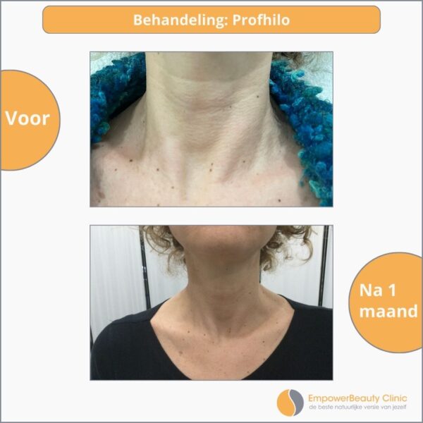 Resultaat Profhilo behandeling